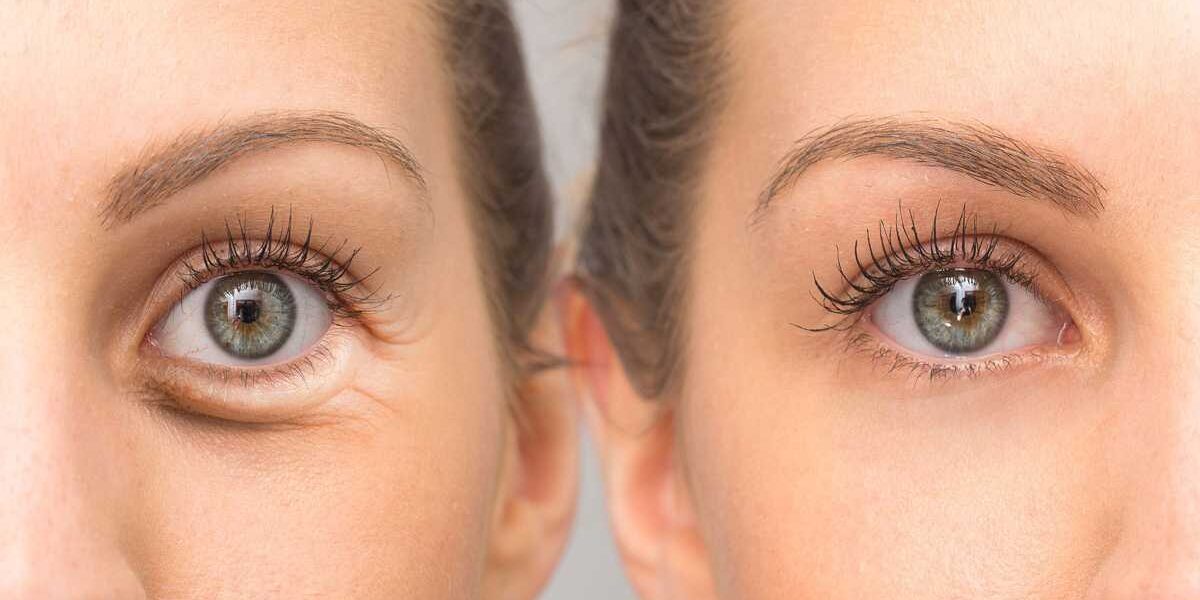 A woman with long eyelashes and an eye bag.