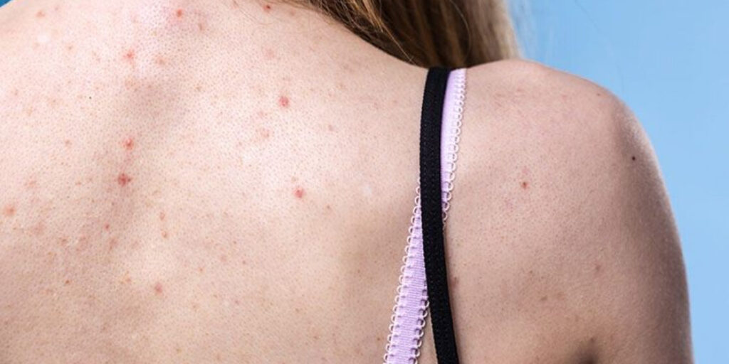 A woman with acne on her back and neck.