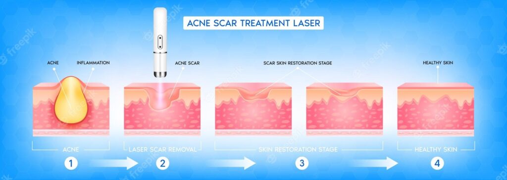 Fraxel Laser Treatment for Acne Scars