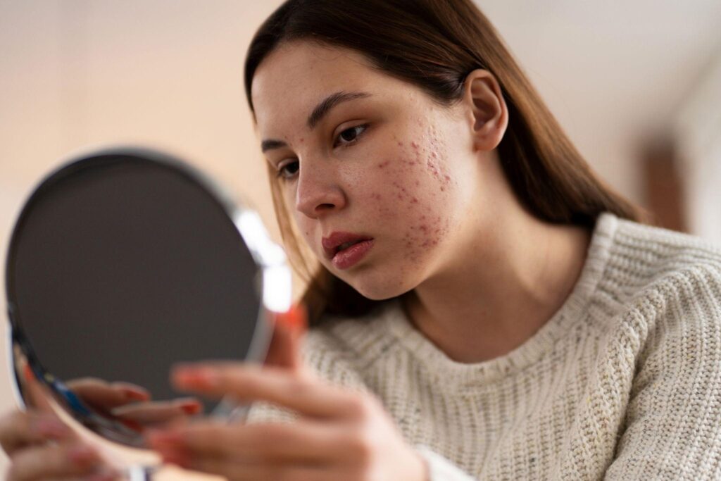 A woman looking at her acne in the mirror.