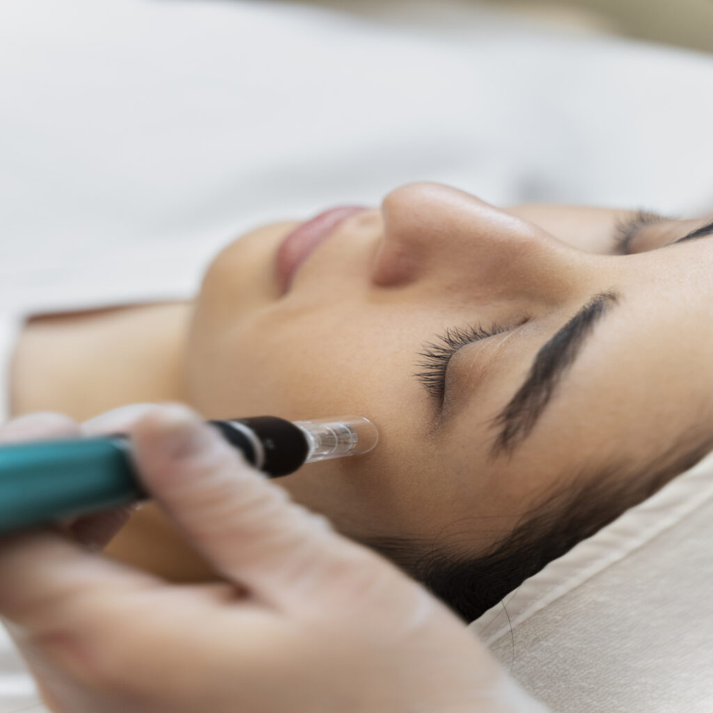 Los Angeles Microneedling