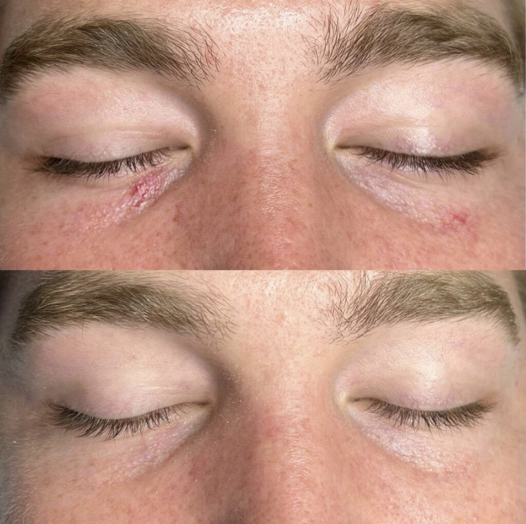 A before and after photo of the same person 's eyes.